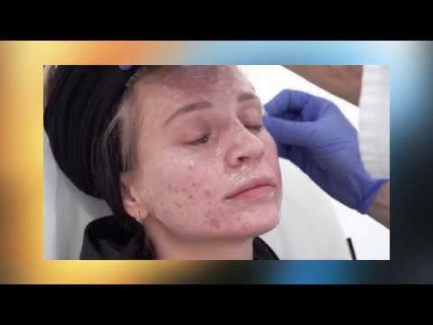 Secret RF procedure performed @levit dermatology